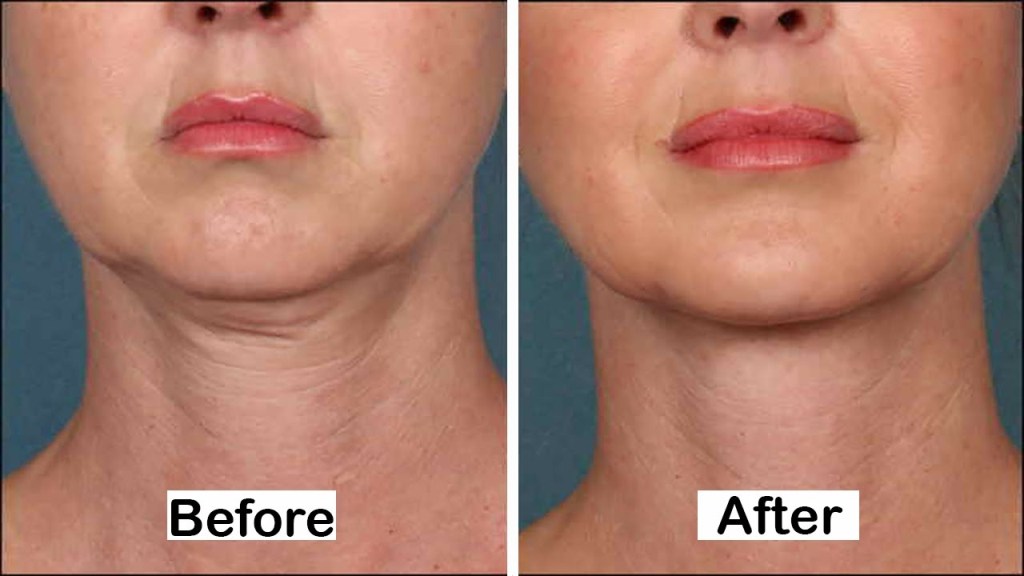 How To Get Rid Of Neck Wrinkles And Neck Lines